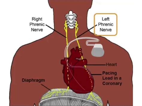 10-13 Moreover, carbon dioxide trapped between the liver and the right diaphragm, irritating the diaphragm, also causes upper abdominal. . Phrenic nerve pain after gallbladder removal